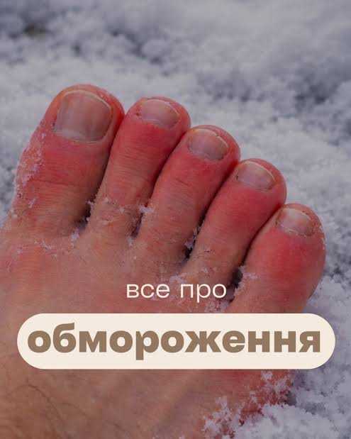 Все про обмороження