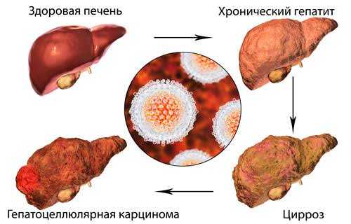 ГЕПАТИТ А
